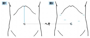 腹腔鏡下手術イメージイラスト