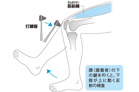膝蓋腱反射検査方法イラスト