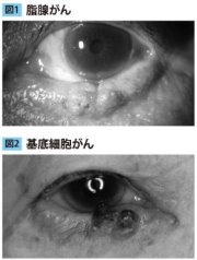目の周りのガン症例写真