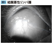 結膜悪性リンパ腫症例写真