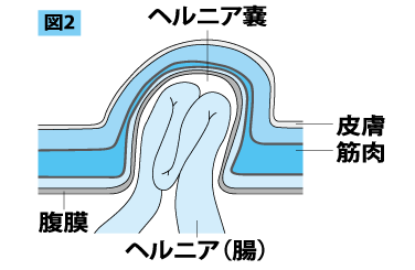 鼠径ヘルニアイメージイラスト