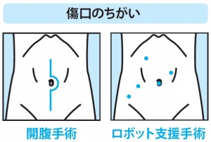 従来の手術とロボット支援手術の傷口の違いイラスト