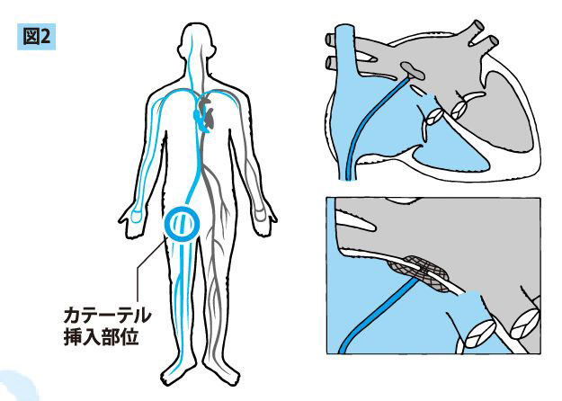 閉鎖栓を用いたカテーテル治療イラスト画像