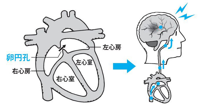 卵円孔開存症発症原理解説イラスト