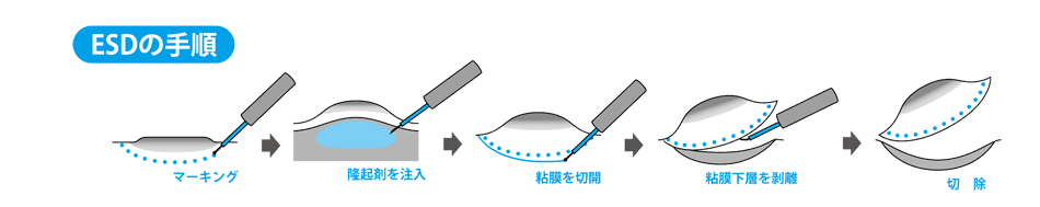 内視鏡治療（ESD）イメージイラスト