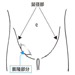 鼠径ヘルニア（脱腸）イメージイラスト