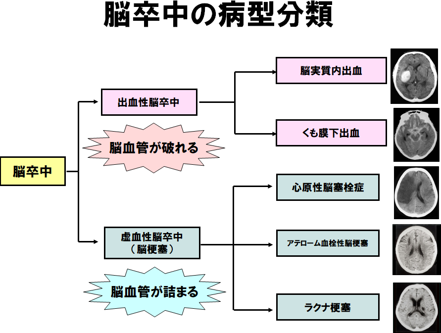 脳卒中の病型分類