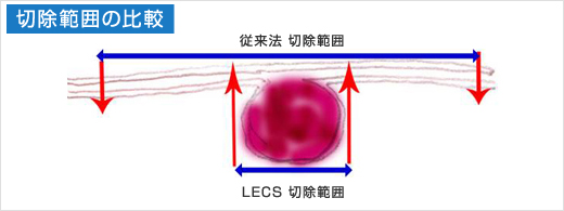 切除範囲の比較