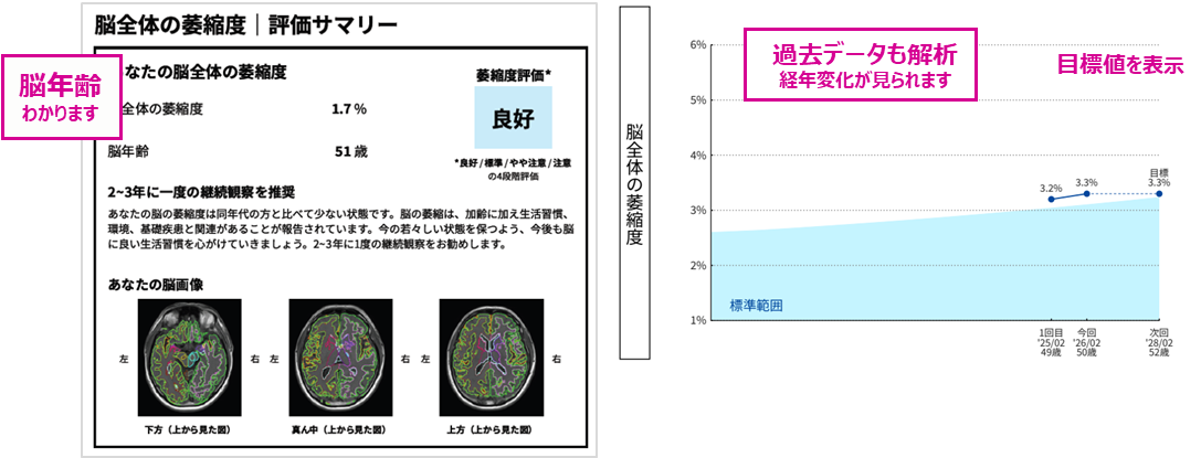 脳全体の萎縮度・脳年齢・脳血管健康度を数値化したレポートをお渡しします。