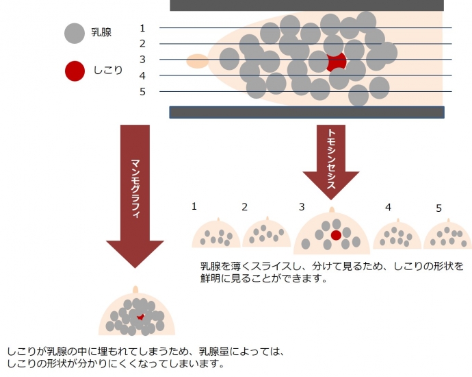 乳房トモシンセシス図説