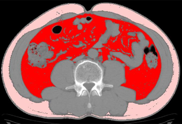 内臓CTスライス画像