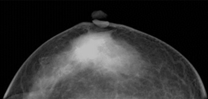 通常の乳房エックス線検査（マンモグラフィ）画像