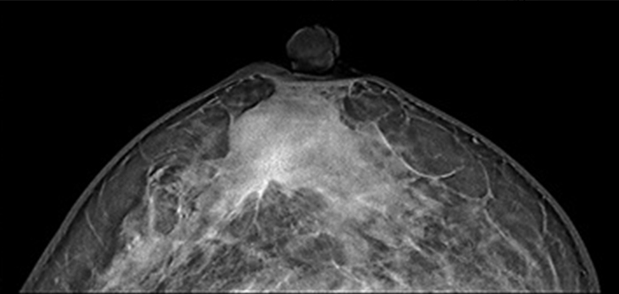乳房トモシンセシス（3Dマンモグラフィ）画像