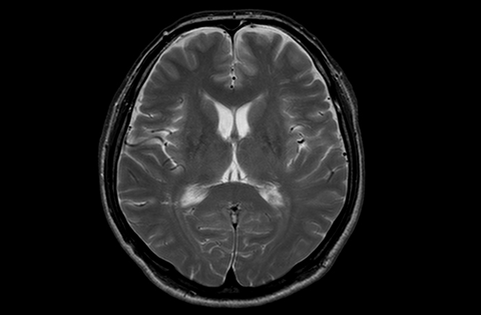 MRI検査画像