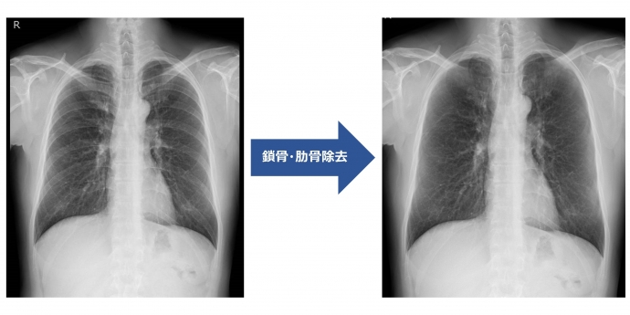 Senciafinder（肋骨減弱処理）