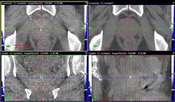 CBCT画像の例（前立腺）