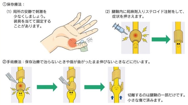 指 手術 費用 バネ 「ばね指」で「手術」と病院で言われたときに！手術を決める前に知っておいた方がいいこと