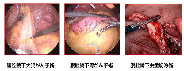 腹腔鏡下大腸がん手術、腹腔鏡下胃がん手術、腹腔鏡下胃がん手術